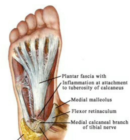 ارتباط بین بیماری های مفصل پا با پاشنه ی کفش 1