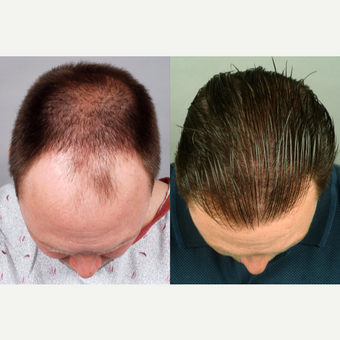 otmf_hair-transplant-before-4824981-3018545.png