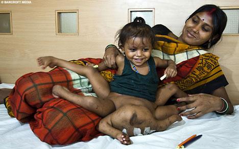 عمل جراحی موفقیت‌آمیز دختر 8 اندامی هندی