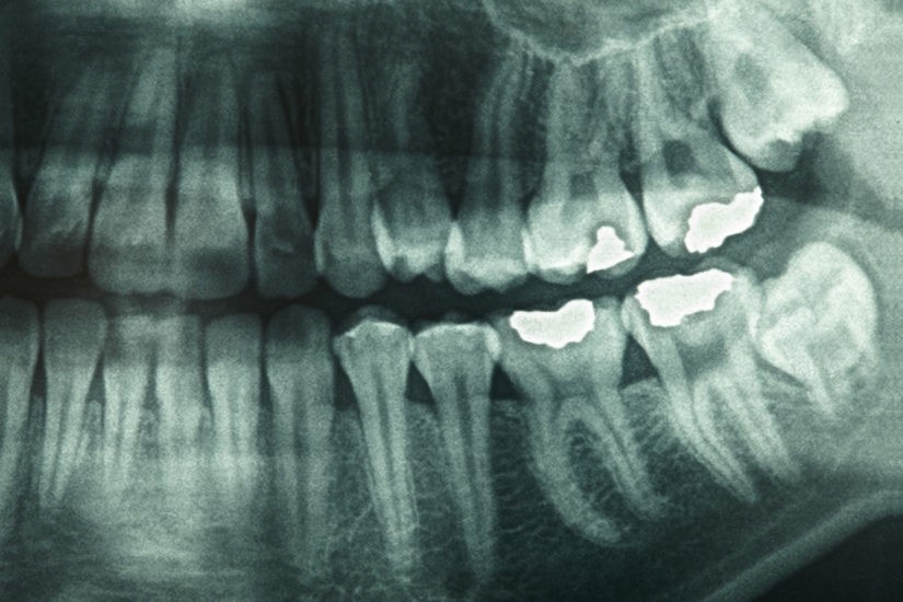 دندان-درد-3