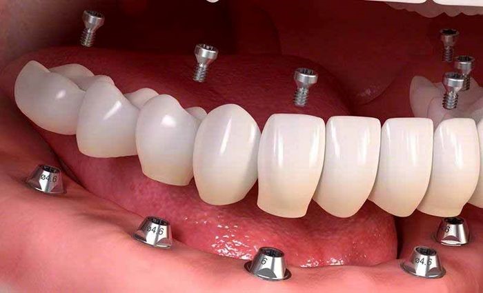 ایمپلنت یکی از روش های درمان ریشه کشیده شده