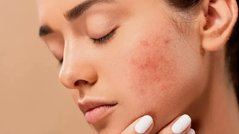 مراقبتهایی برای جلوگیری از جوش زدن